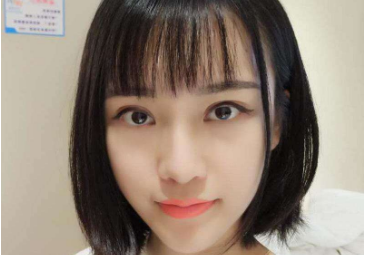 大連宏冠醫(yī)療雙眼皮修復后效果