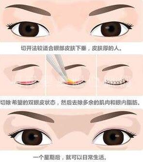 廣州廣大整形美容醫(yī)院切開(kāi)雙眼皮術(shù)后效果