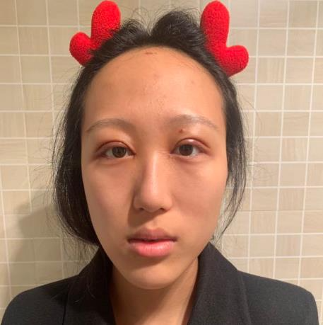 上海華美醫(yī)療美容醫(yī)院楊亞益做眼部修復(fù)整形怎么樣？