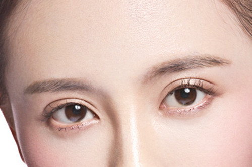 菏澤華美整形美容醫(yī)院開內(nèi)眼角術(shù)后效果