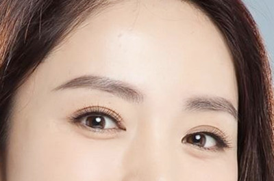 衡陽愛思特醫(yī)療美容醫(yī)院開眼角術(shù)后效果
