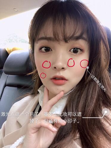 激光點痣一個月的效果 激光點痣一個月的效果