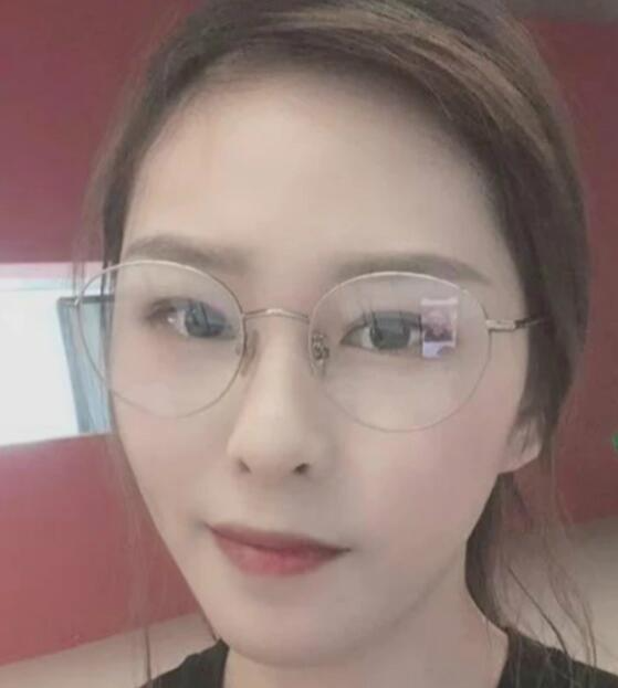 濟(jì)南海峽整形醫(yī)院陳娜醫(yī)生激光祛斑案例分享