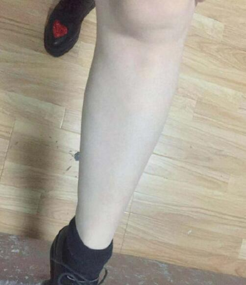 湖州尚麗醫(yī)療美容門(mén)診部宋君醫(yī)生激光脫毛案例分享