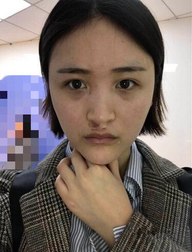 隆鼻術(shù)前效果