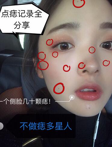 做激光點痣之前的效果 做激光點痣之前的效果