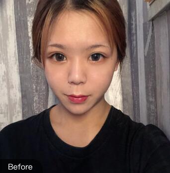 做自體脂肪填充手術前 做自體脂肪填充手術前