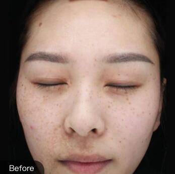 激光祛斑案例手術(shù)前 激光祛斑案例手術(shù)前