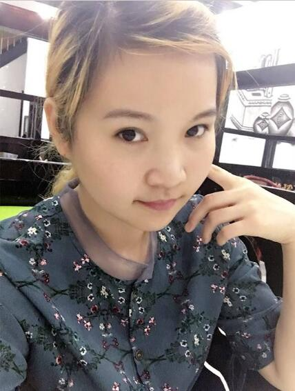 廈門華美名媛整形醫(yī)生賈虹下頜角削骨案例效果對比圖！