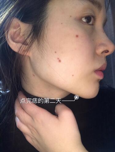 激光點痣的第二天 激光點痣的第二天