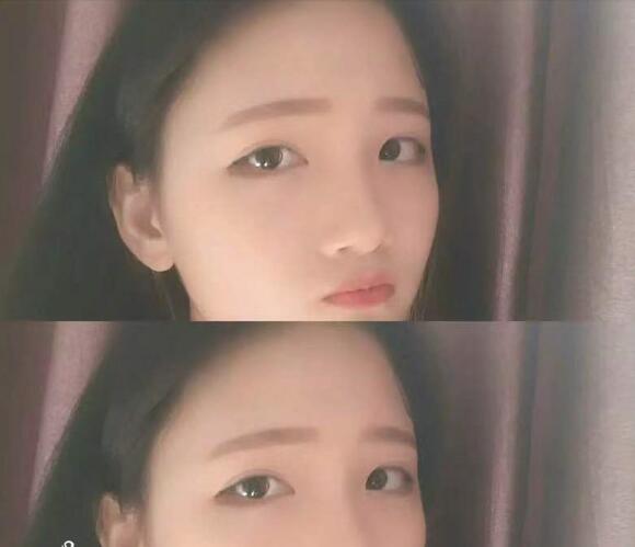 做切開(kāi)雙眼皮恢復(fù)后的我 做切開(kāi)雙眼皮恢復(fù)后的我