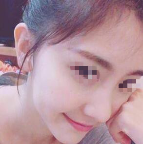 耳軟骨隆鼻手術(shù)之前