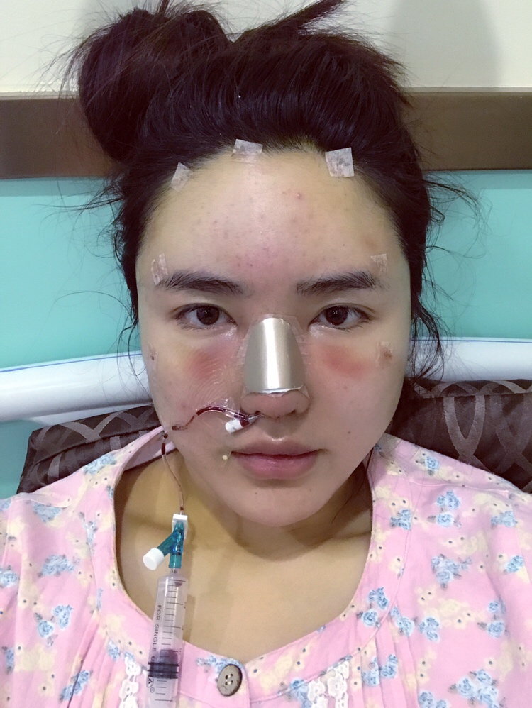 膨體隆鼻手術(shù)過(guò)程