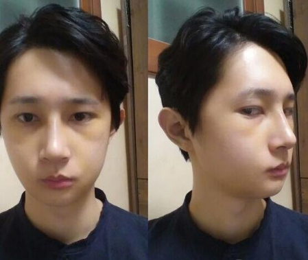 重慶三峽中心醫(yī)院頜面外科張宇下頜角案例手術(shù)效果對比圖