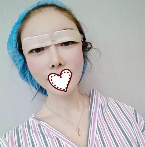 剛做完雙眼皮手術(shù)，還在恢復(fù)過程中