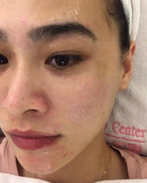 做完光子嫩膚之后