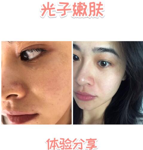 福州愛(ài)思特比華利整形林秋蓉醫(yī)生做光子嫩膚過(guò)程體驗(yàn)