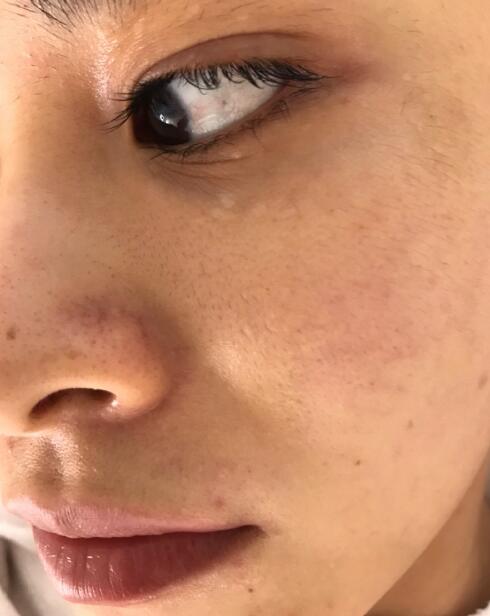 做光子嫩膚手術(shù)之前