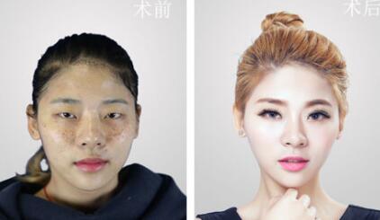 福州愛思特比華利整形林秋榮激光祛斑案例效果對比圖