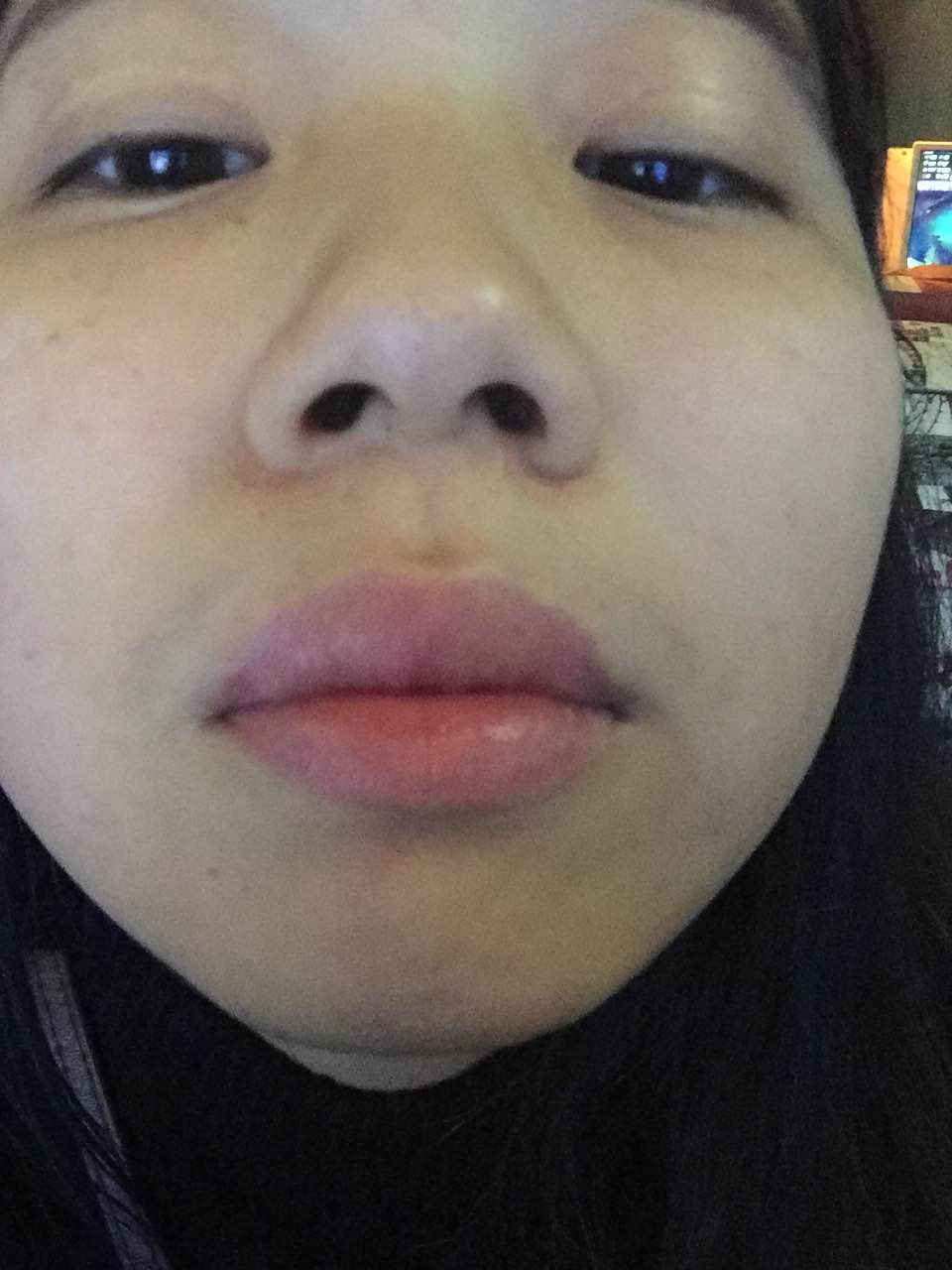 滄州瑞美醫(yī)療美容門診部整形醫(yī)生王波鼻骨縮窄案例