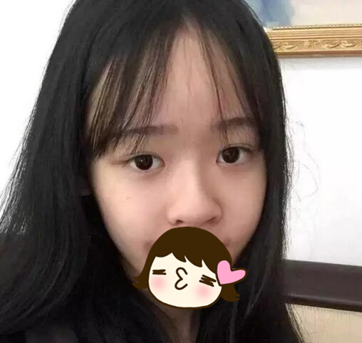 廈門海峽整形美容醫(yī)院隆鼻手術案例效果