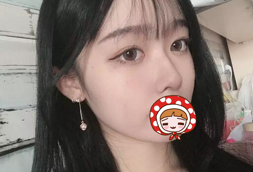 廈門海峽整形美容醫(yī)院隆鼻手術案例最終效果