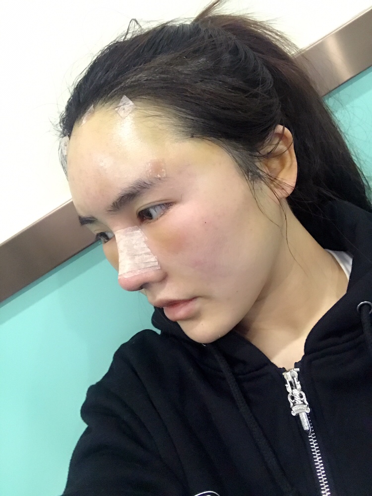 膨體隆鼻手術(shù)過(guò)程