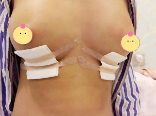 琴面假體隆胸手術剛結束的時候 琴面假體隆胸手術剛結束的時候