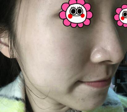 做完彩光嫩膚后的效果