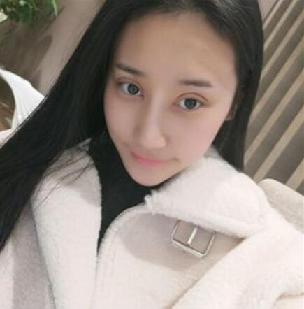 北京葉子整形美容醫(yī)院做焊接雙眼皮效果怎么樣？北京葉子整形焊接雙眼皮案例展示