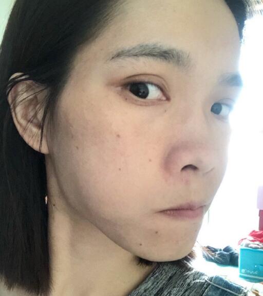 廖苑利光子嫩膚案例效果展示: 廖苑利光子嫩膚案例效果展示: