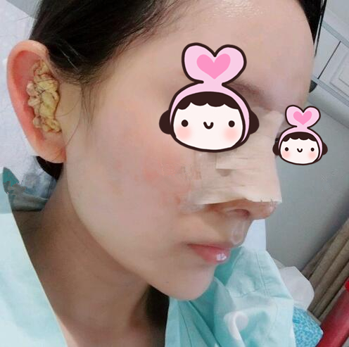 廈門海峽整形專家王翼耕做隆鼻案例分享