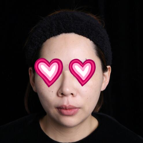 西安儷人醫(yī)院整形醫(yī)生蘇鵬做隆鼻技術怎么樣？附蘇鵬醫(yī)生隆鼻案例