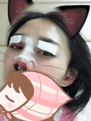 北京延世醫(yī)療整形專家周宜國做開外眼角技術怎么樣？