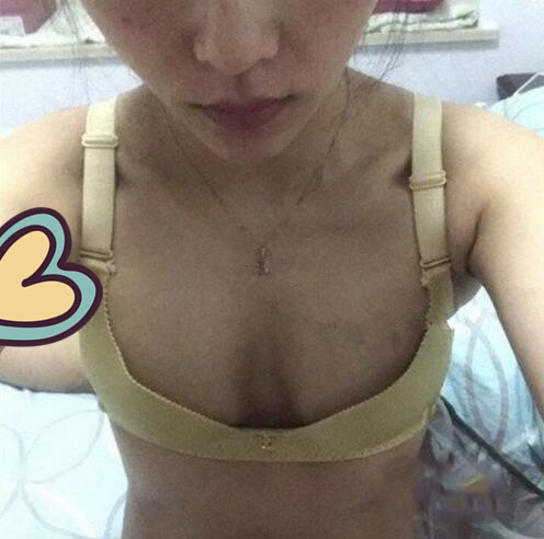 廣州駐顏光醫(yī)療美容診所整形專(zhuān)家劉培做復(fù)合隆胸技術(shù)怎么樣?附案例 廣州駐顏光醫(yī)療美容診所整形專(zhuān)家劉培做復(fù)合隆胸技術(shù)怎么樣?附案例