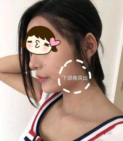 磨骨手術(shù)之前 磨骨手術(shù)之前