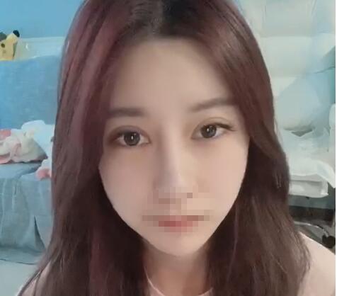 鼻綜合整形手術恢復效果