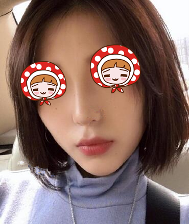 北京京韓醫(yī)療硅膠隆鼻案例 北京京韓醫(yī)療硅膠隆鼻案例