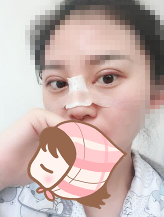 術(shù)后60天效果。