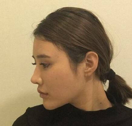 下頜角手術(shù)第一天: 下頜角手術(shù)第一天: