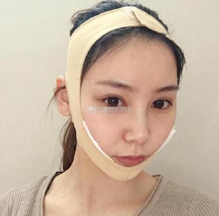 下頜角手術(shù)第一天: 下頜角手術(shù)第一天: