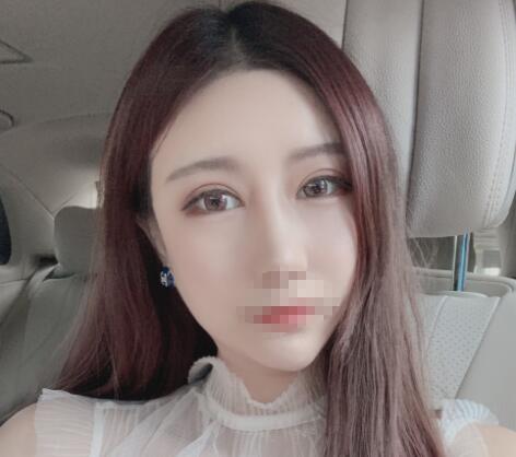 北京彤美整形醫(yī)院專家李長賦做鼻部綜合整形怎么樣?李長賦鼻綜合案例反饋