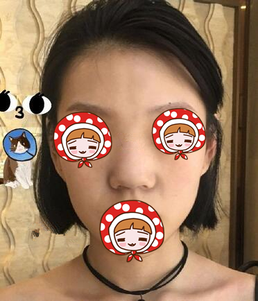 北京京韓醫(yī)療美容診所做硅膠隆鼻效果怎么樣？北京京韓醫(yī)療硅膠隆鼻案例