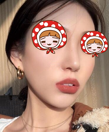 北京京韓醫(yī)療硅膠隆鼻案例 北京京韓醫(yī)療硅膠隆鼻案例