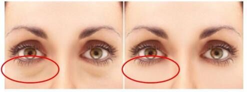 上海賽美瑞整形激光祛眼袋
