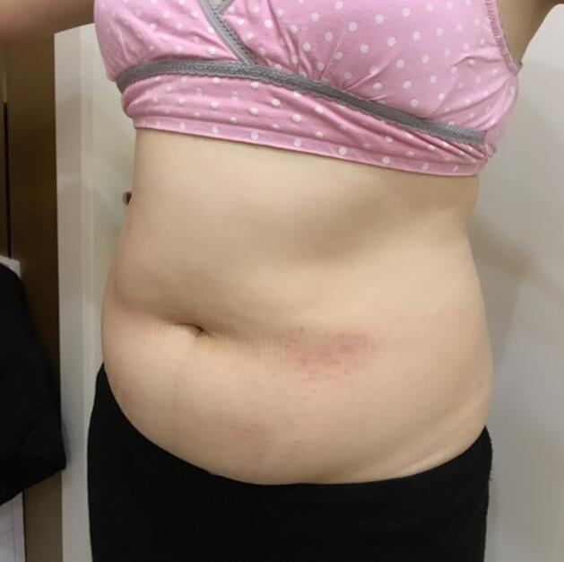 廣州星團(tuán)醫(yī)學(xué)整形醫(yī)生顧鵬做腹部吸脂效果怎么樣？顧鵬腹部吸脂案例展示