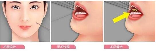 酒窩成形術(shù)介紹