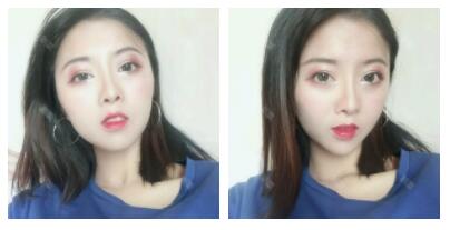 深圳嶺南醫(yī)院整形醫(yī)生丁祖鑫做假體豐太陽(yáng)穴案例效果對(duì)比圖 深圳嶺南醫(yī)院整形醫(yī)生丁祖鑫做假體豐太陽(yáng)穴案例效果對(duì)比圖