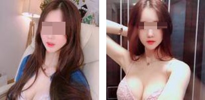 沈陽杏林整形美容醫(yī)院崔昌墉醫(yī)生做假體隆胸技術(shù)怎么樣？附案例