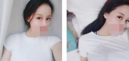 寧波美仁整形美容醫(yī)院李英大醫(yī)生做切開雙眼皮效果怎么樣？